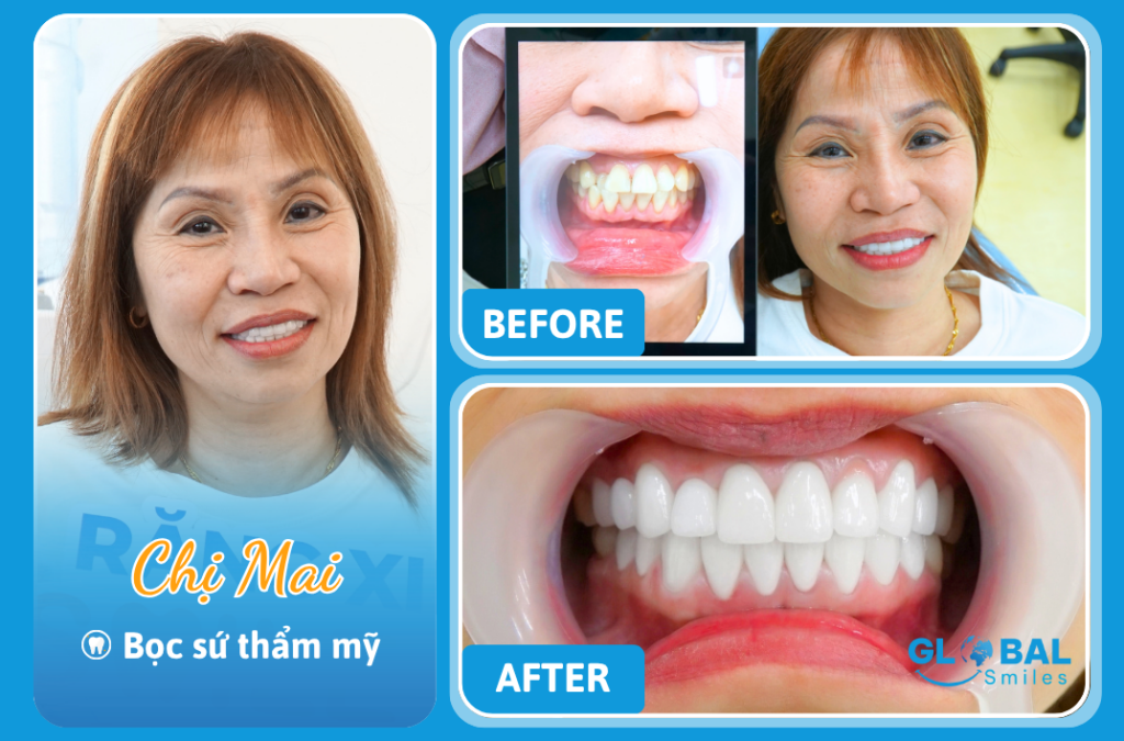 Lột xác nụ cười ngoạn mục nhờ 25 răng sứ thẩm mỹ cao cấp – Hành trình quay lại tuổi thanh xuân của chị Mai