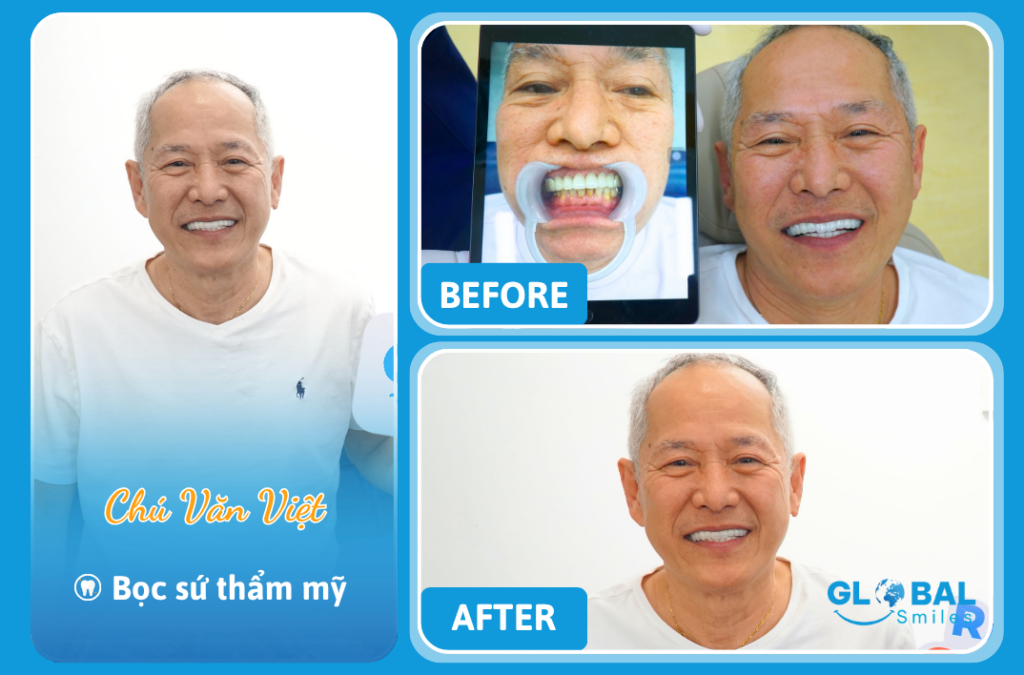 Chú Việt – Tạm biệt răng ố vàng, nụ cười bừng sáng nhờ làm răng sứ thẩm mỹ cao cấp