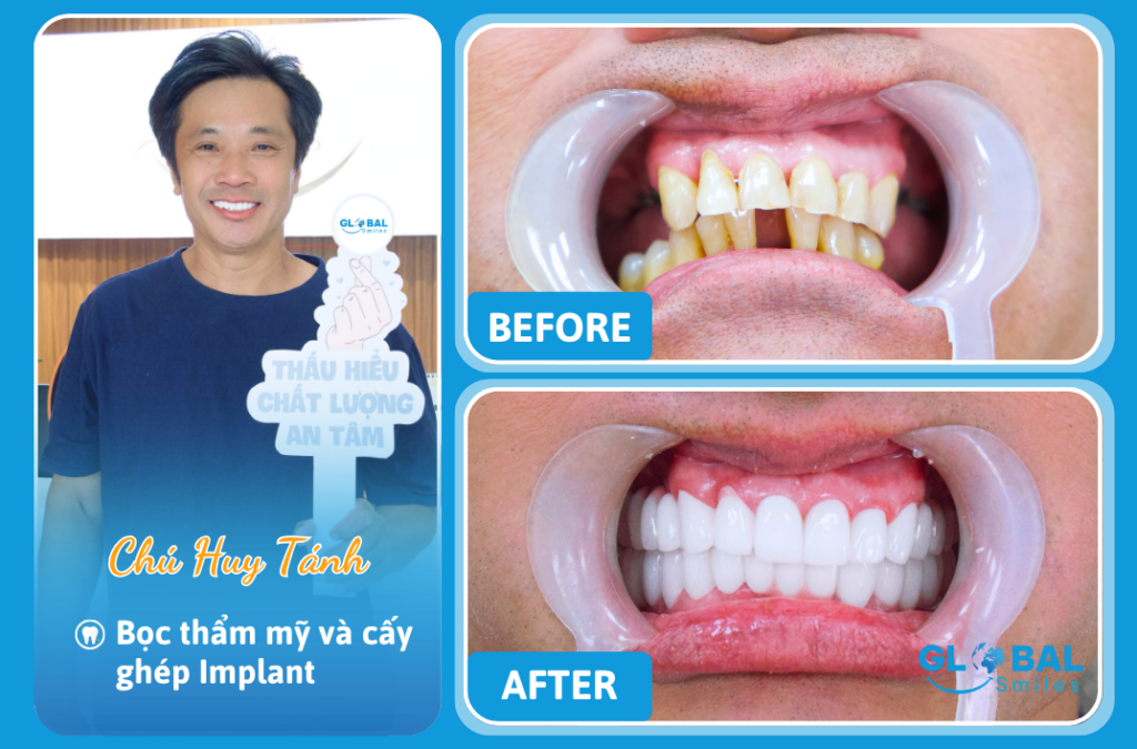 Chú Huy Tánh – Tạm biệt hàm răng xuống cấp nhờ bọc sứ và trồng implant, lấy lại nụ cười phong độ tuổi trung niên