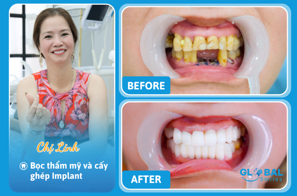 Hành trình lấy lại nụ cười rạng rỡ của chị Linh nhờ bọc sứ và Implant toàn diện