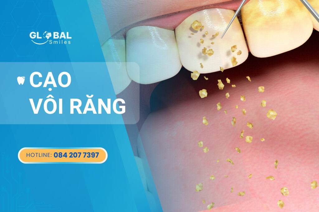 Lý do bạn nên cạo vôi răng định kỳ để bảo vệ răng miệng