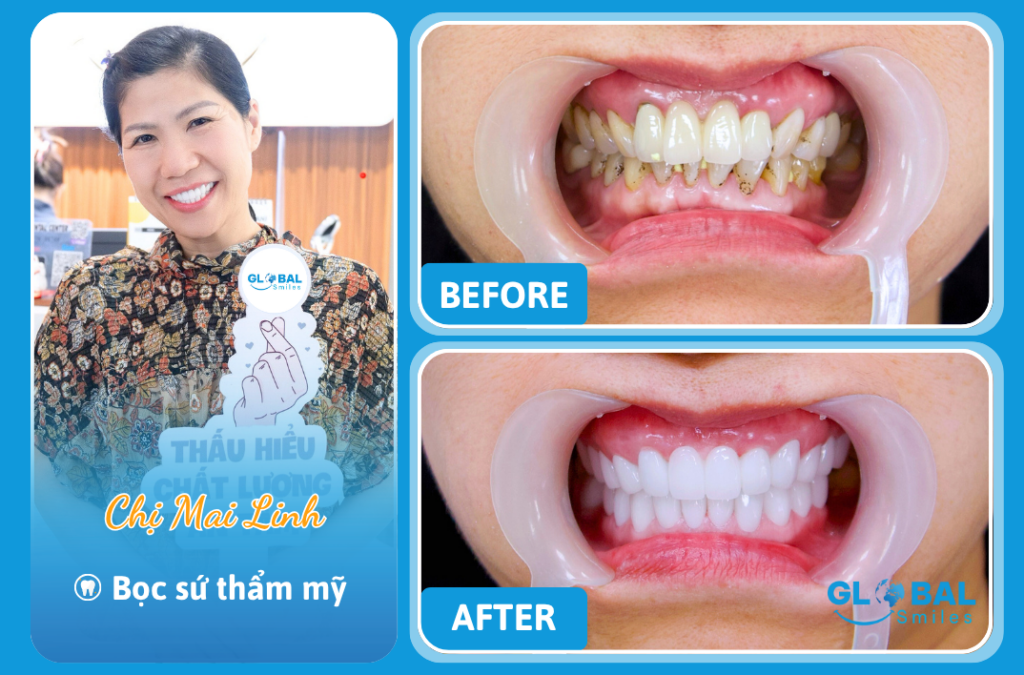 Chị Mai Linh – Bọc sứ thẩm mỹ để yêu lại chính mình ở tuổi không còn đôi mươi