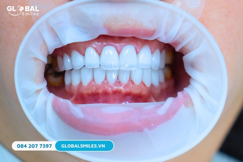 Bọc răng sứ là gì