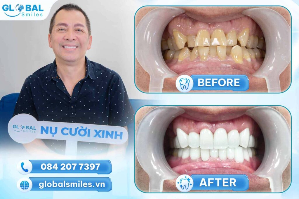 hình ảnh khách hàng bọc răng sứ lava tại nha khoa global smile
