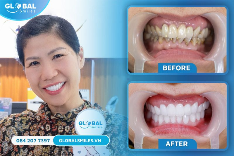 Hình ảnh khách hàng bọc răng sứ tại Nha khoa Global Smile
