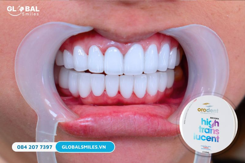 Răng sứ Orodent