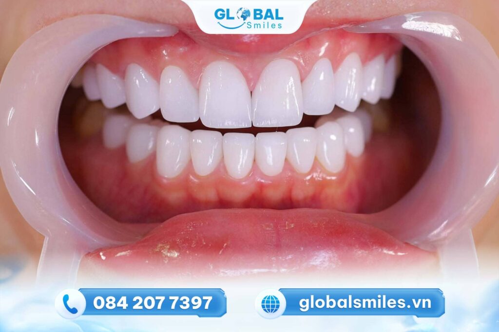 Răng sứ Zirconia có tốt không?