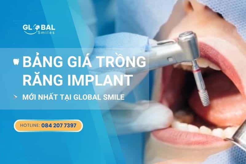 Bảng giá trồng răng Implant mới nhất Nha khoa Global Smile
