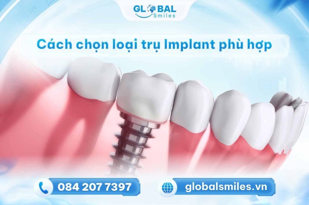 Cách chọn trụ Implant phù hợp