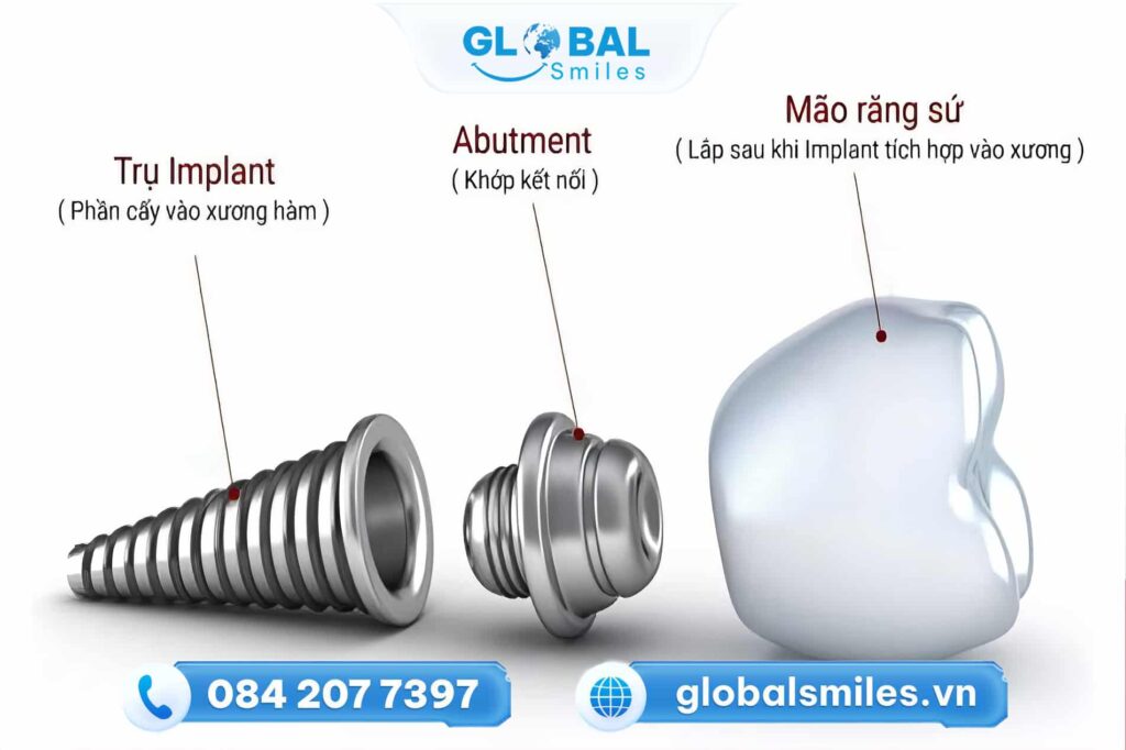 Cấu tạo của răng Implant