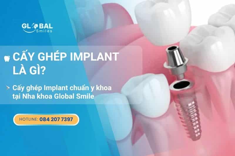 Cấy ghép Implant là gì? Tất tần tật về cấy ghép Implant chuẩn y khoa tại Global Smiles