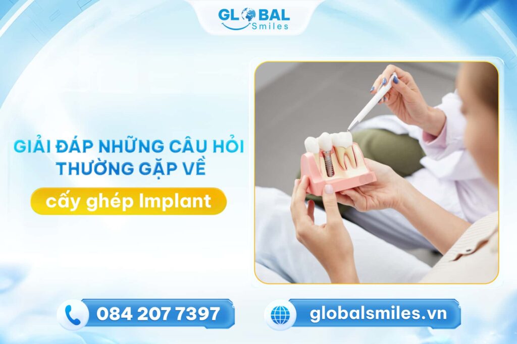 Giải đáp những câu hỏi thường gặp về Implant