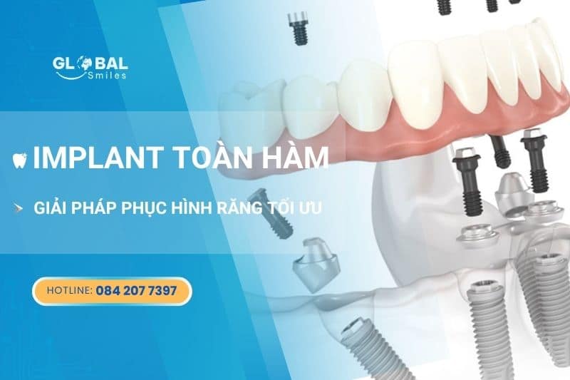 Implant toàn hàm – Giải pháp phục hình răng tối ưu