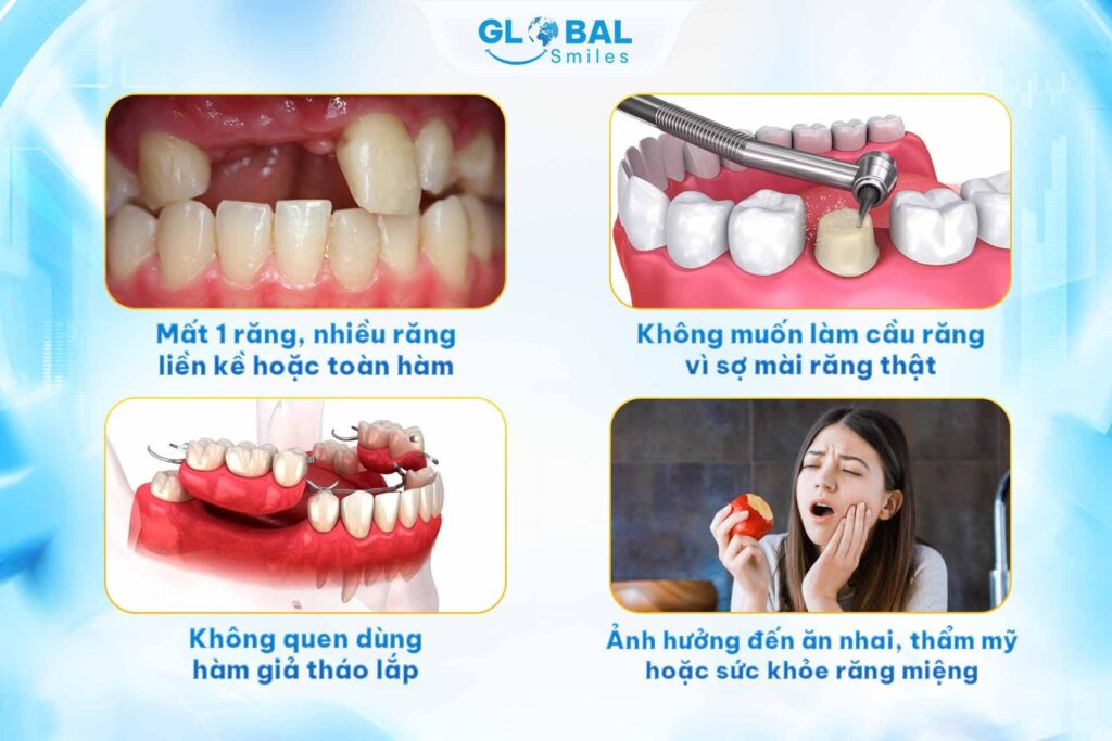 Những trường hợp nên trồng răng Implant