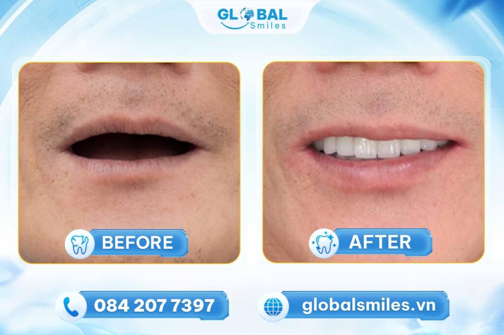 Những ai nên trồng răng Implant toàn hàm