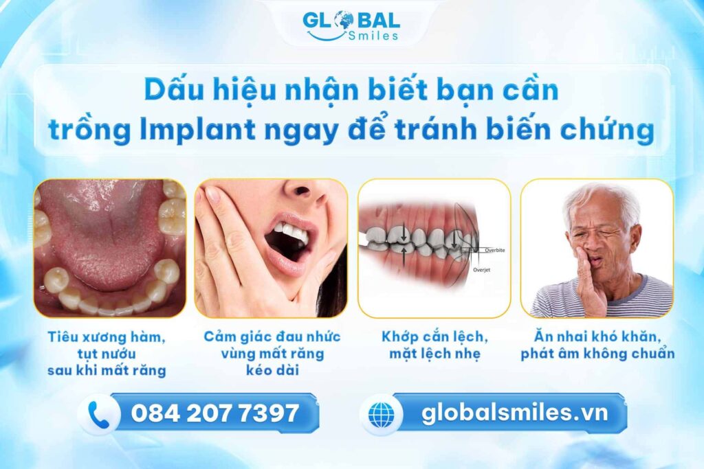 Những dấu hiệu nhận biết bạn nên trồng răng Implant