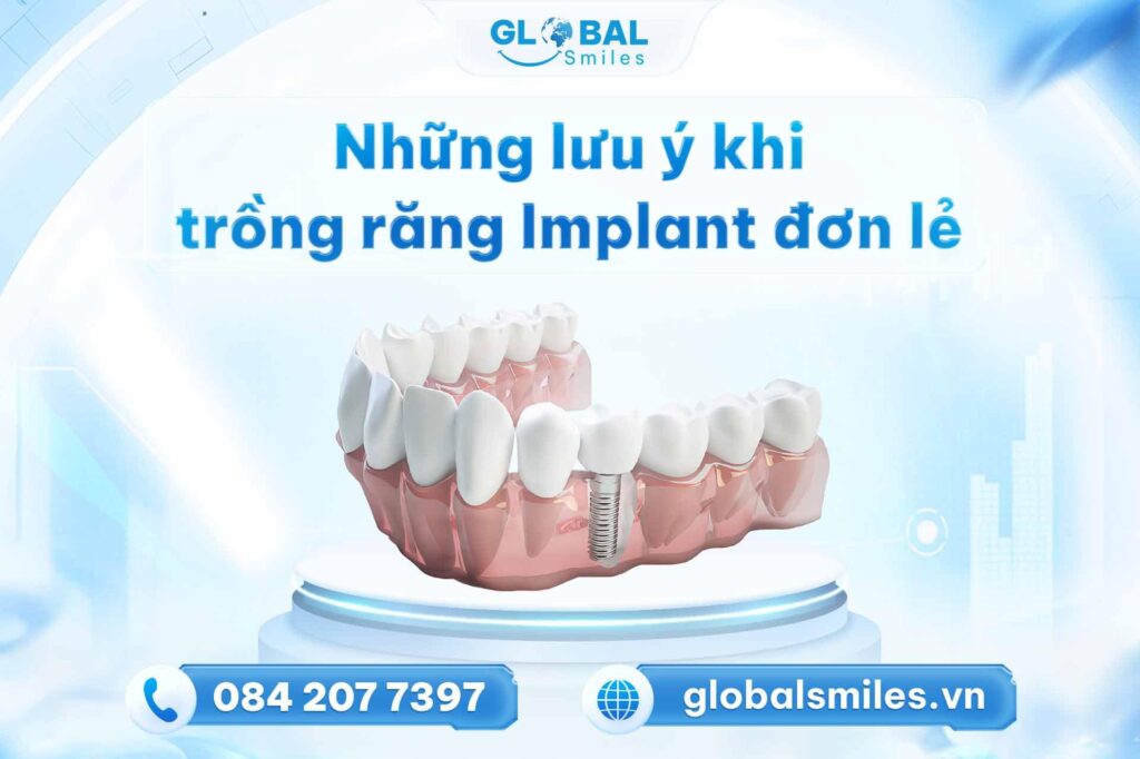 Những lưu ý khi trồng răng Implant đơn lẻ