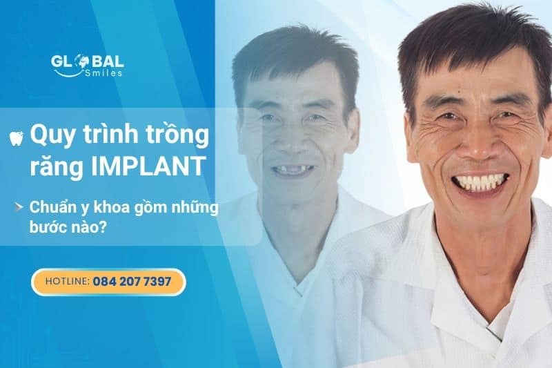 Quy trình trồng răng Implant đạt chuẩn y khoa quốc tế