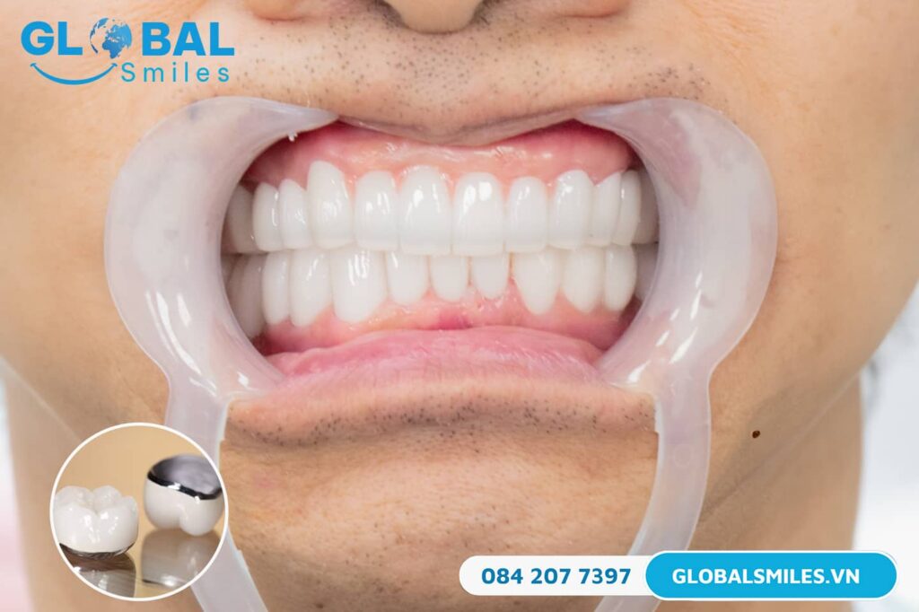 Răng sứ Chrome - Cobalt