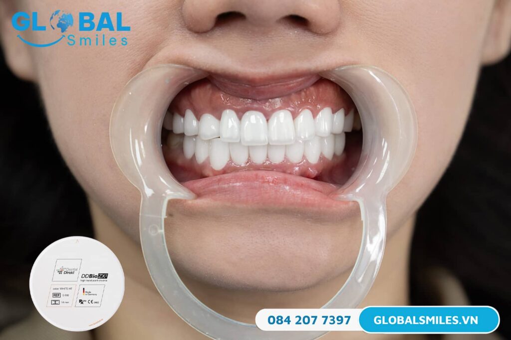 Răng sứ DDBIO