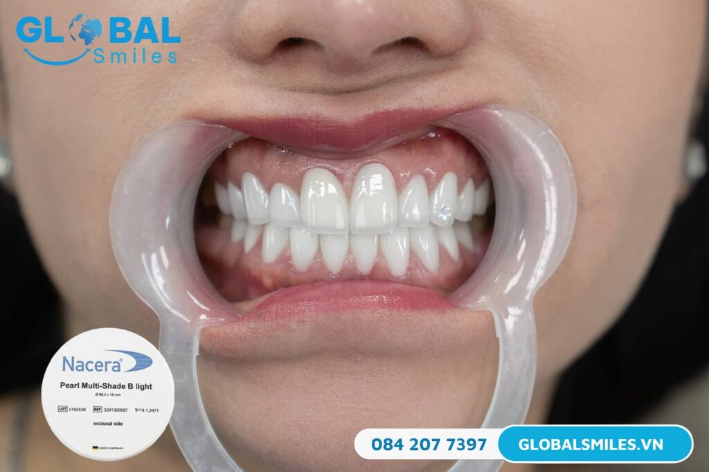 Răng sứ Nacera Plus