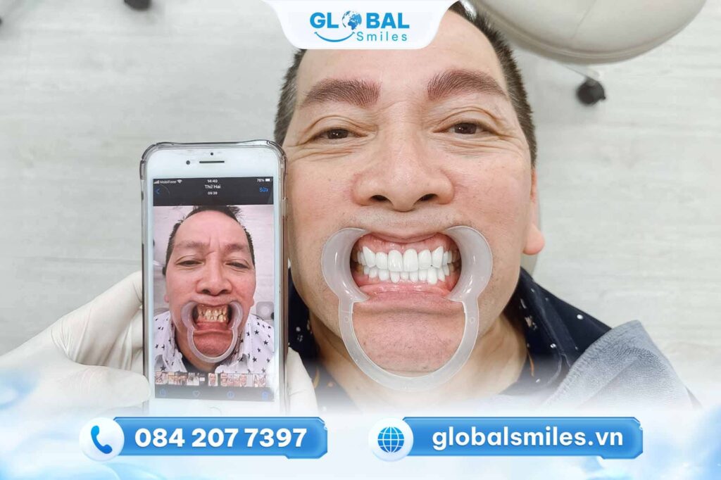 Răng sứ thẩm mỹ là gì