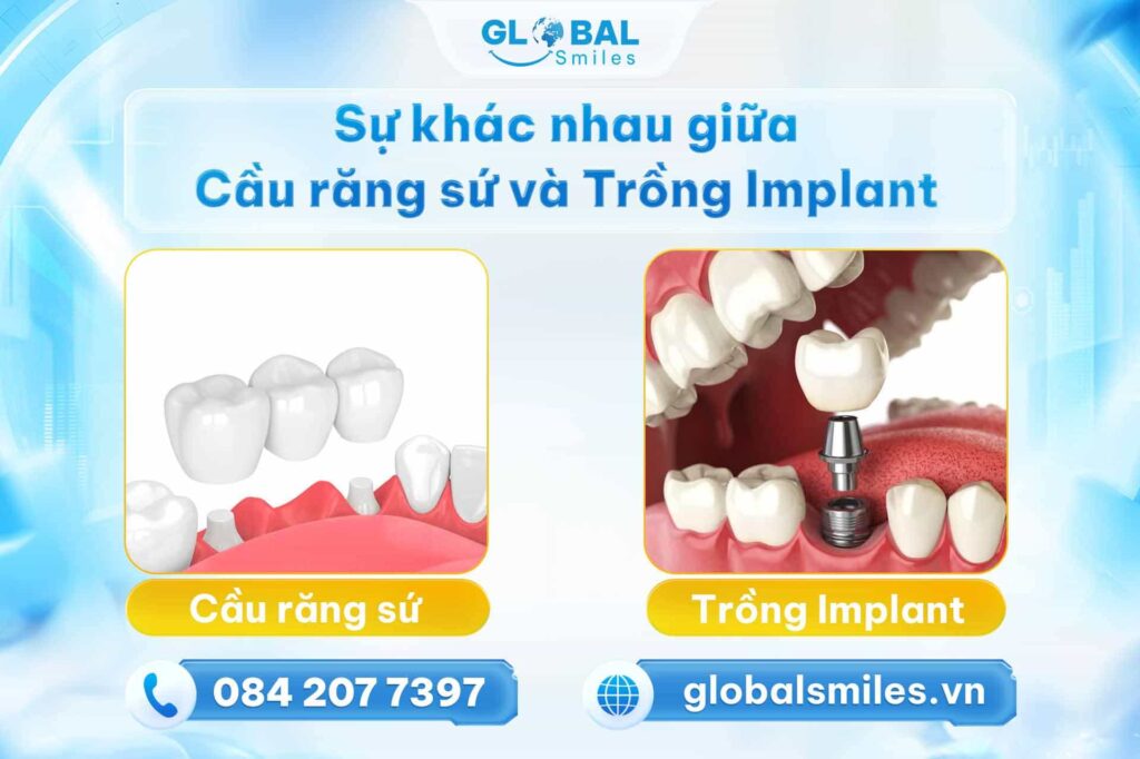Sự khác nhau giữa trồng răng Implant và cầu răng sứ
