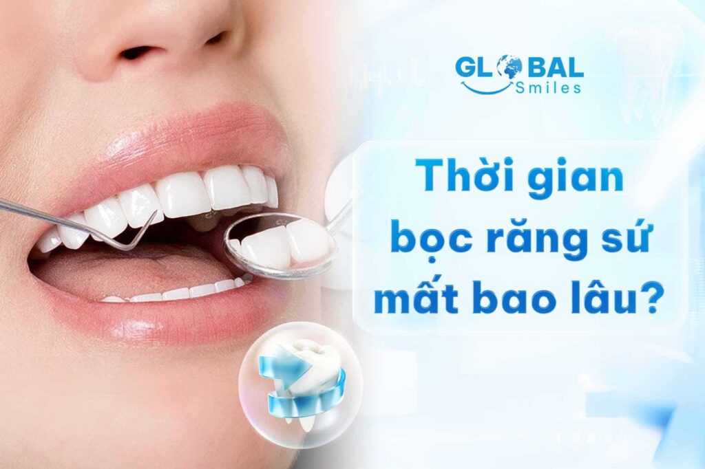 Thời gian bọc răng sứ mất bao lâu