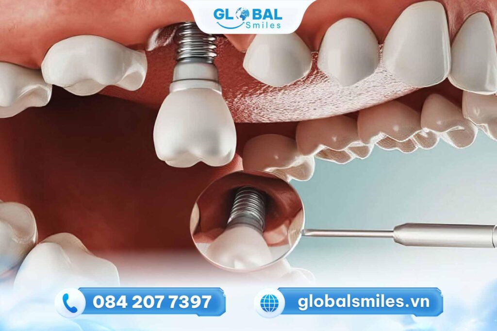 Trồng răng Implant có đau không?