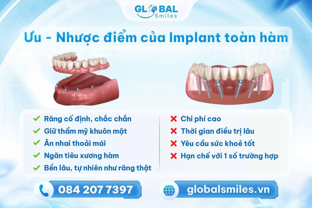 Ưu nhược điểm của Implant toàn hàm